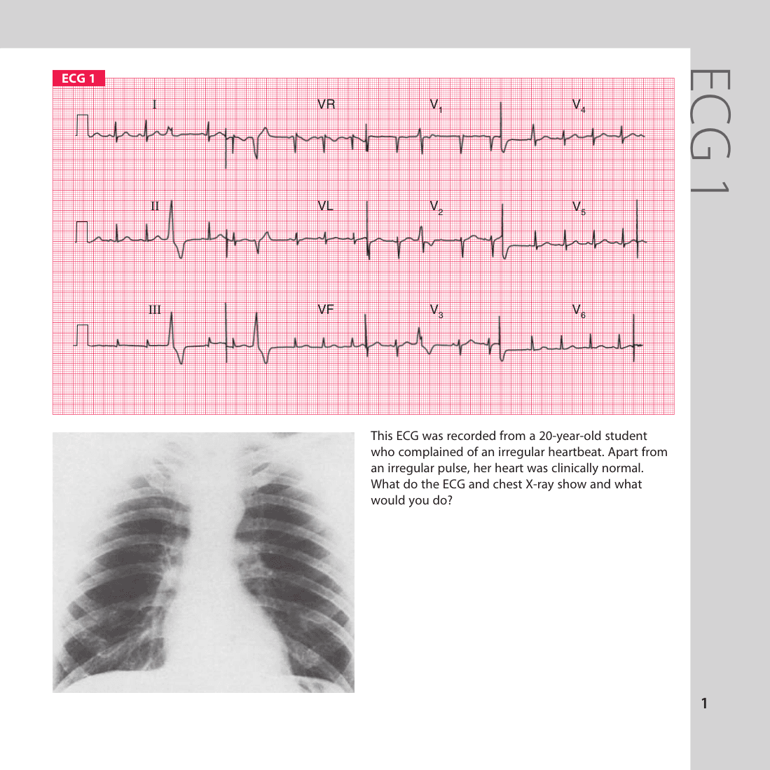 ECG 1