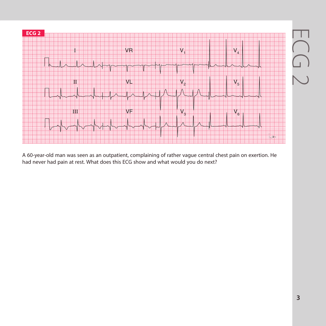 ECG 2