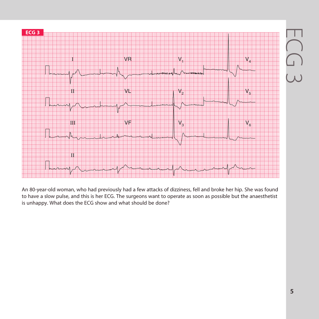 ECG 3