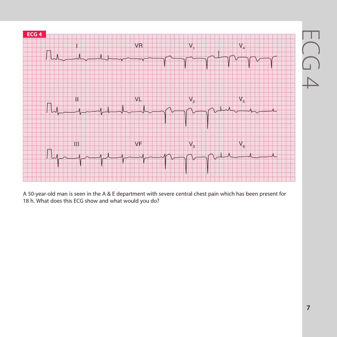 ECG 4