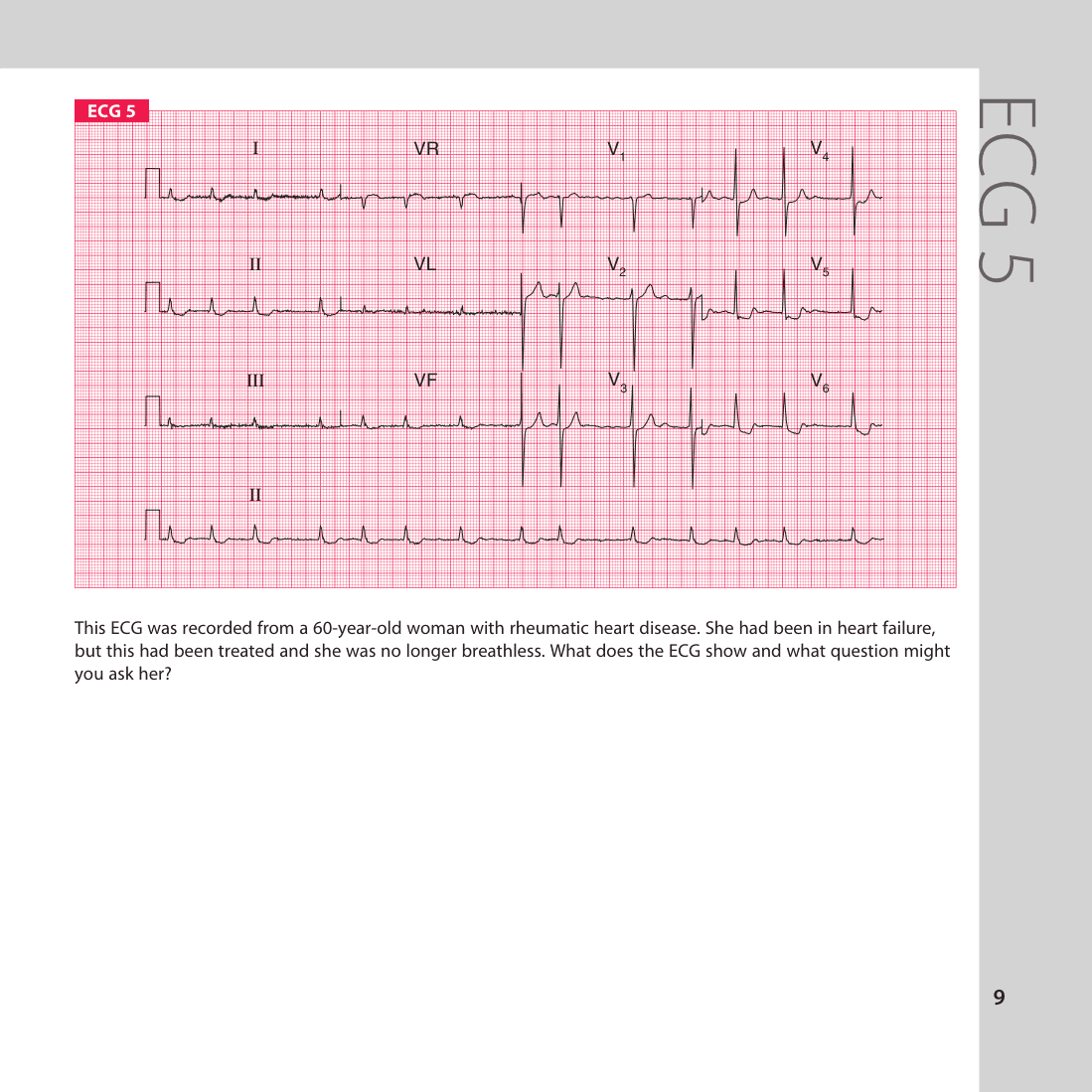 ECG 5