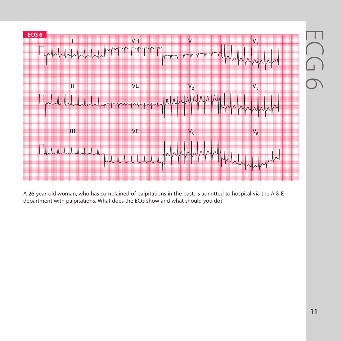 ECG 6