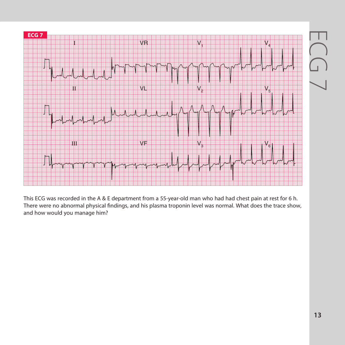 ECG 7
