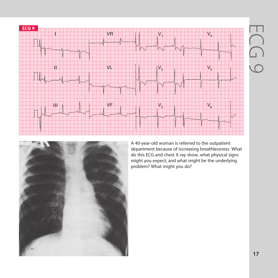 ECG 9