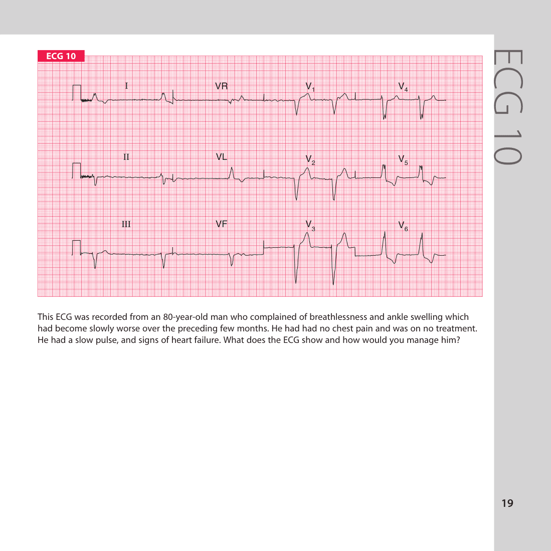 ECG 10