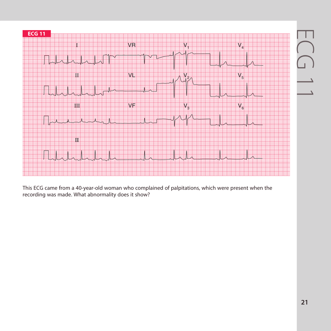 ECG 11