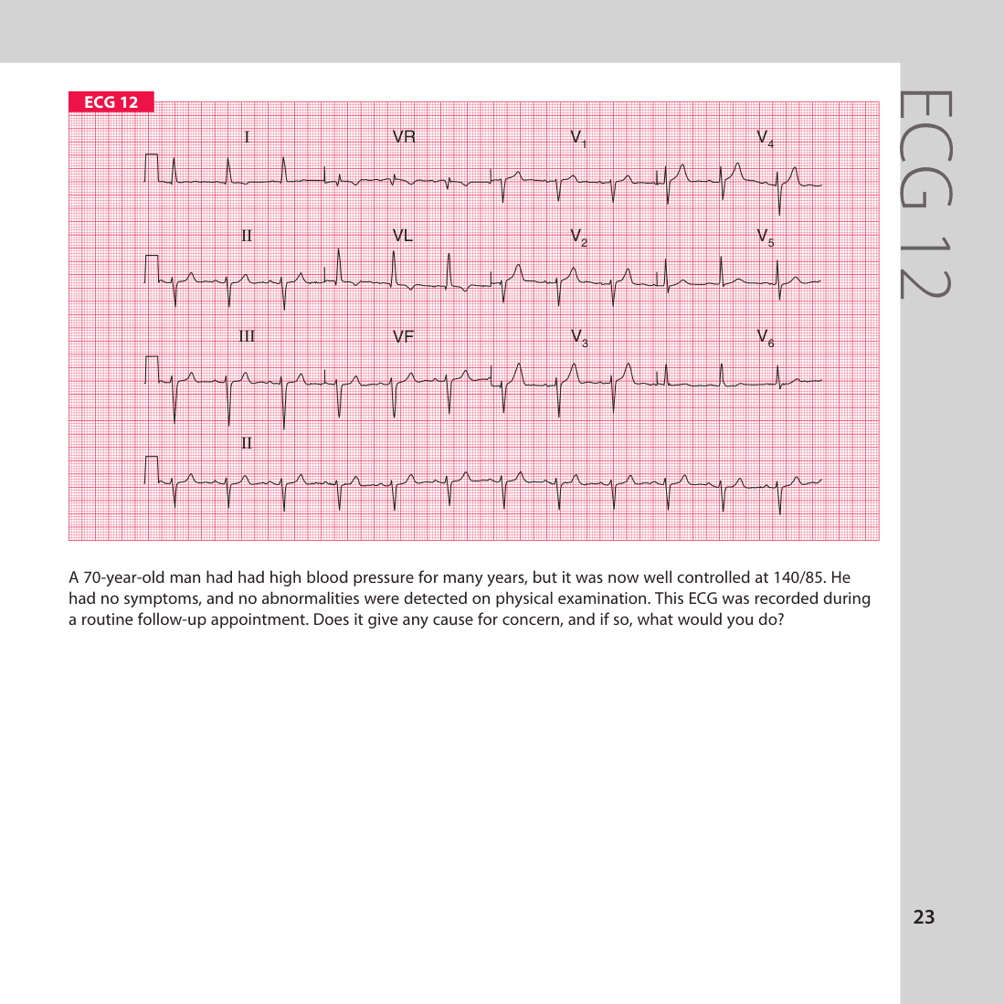 ECG 12