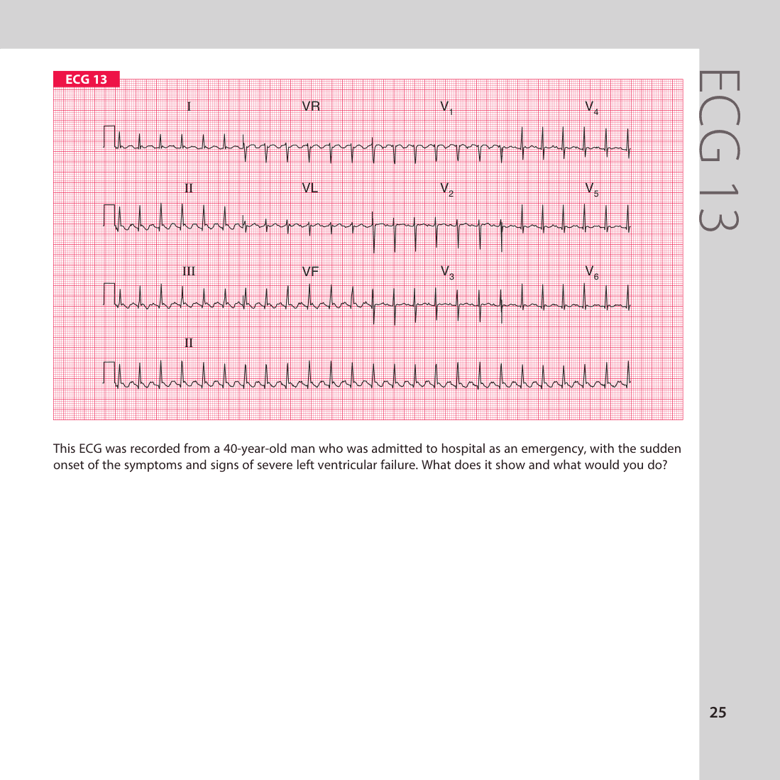 ECG 13