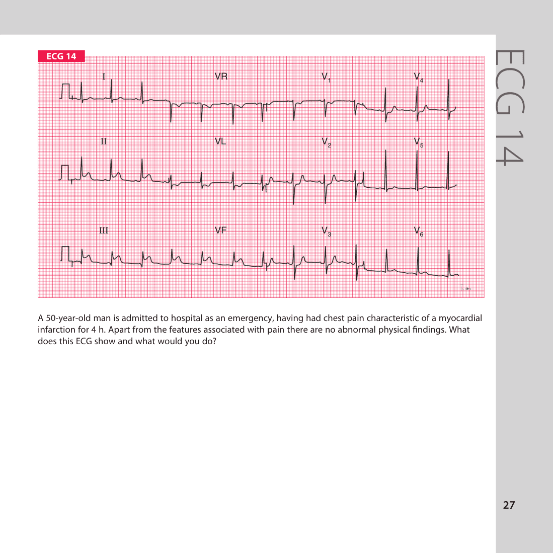 ECG 14