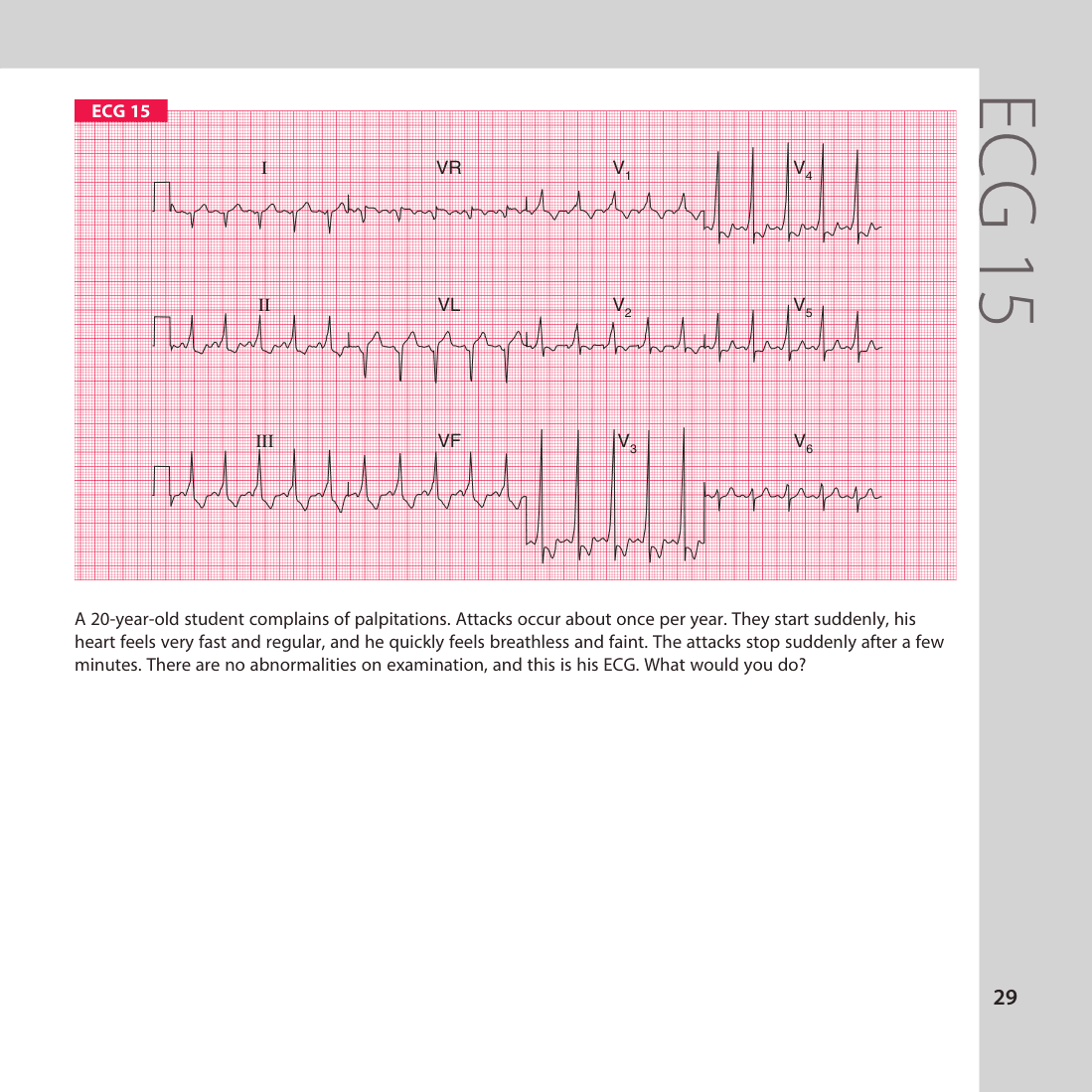 ECG 15