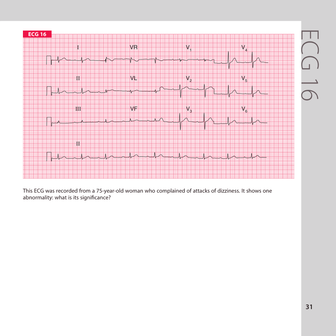 ECG 16