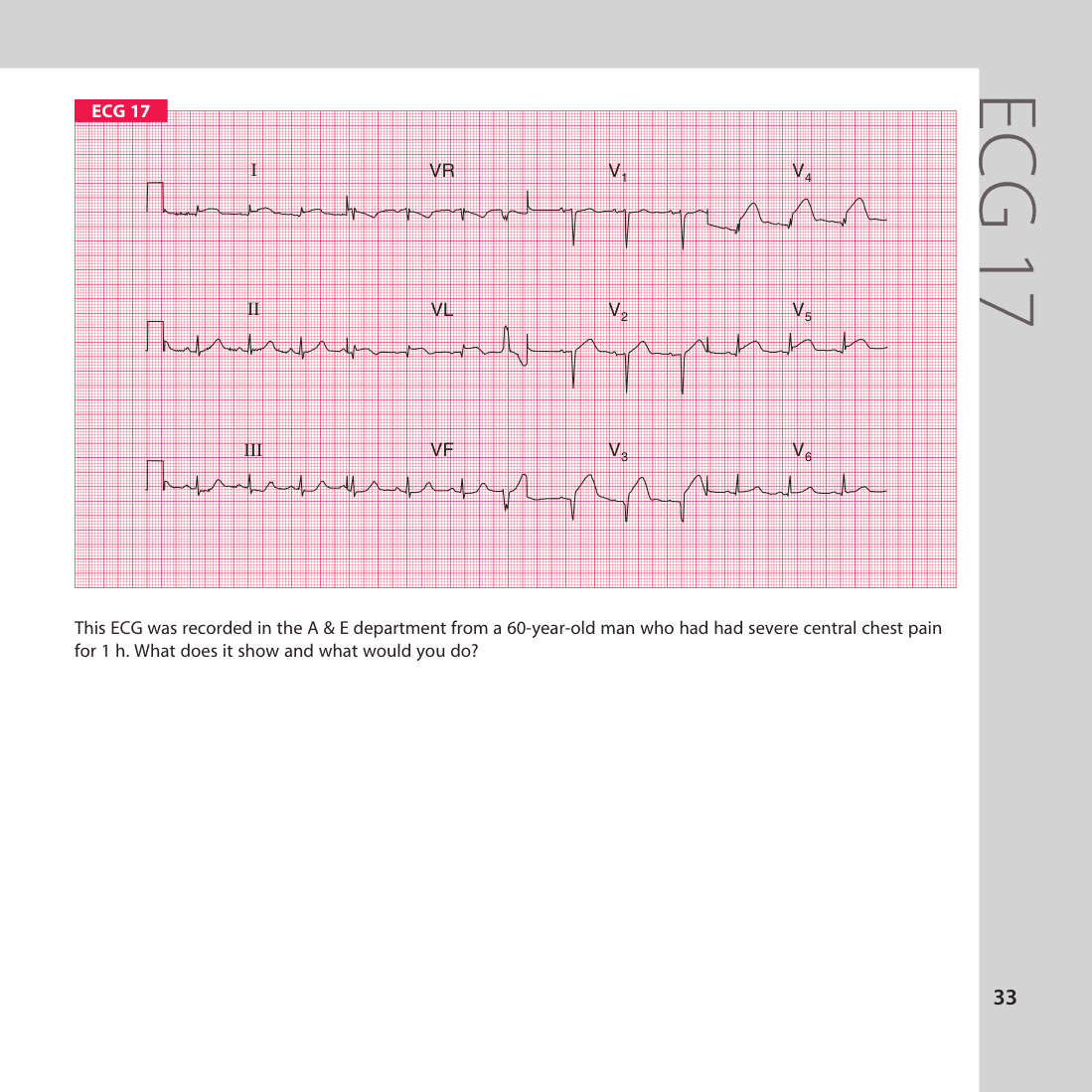 ECG 17