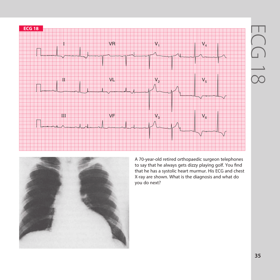 ECG 18
