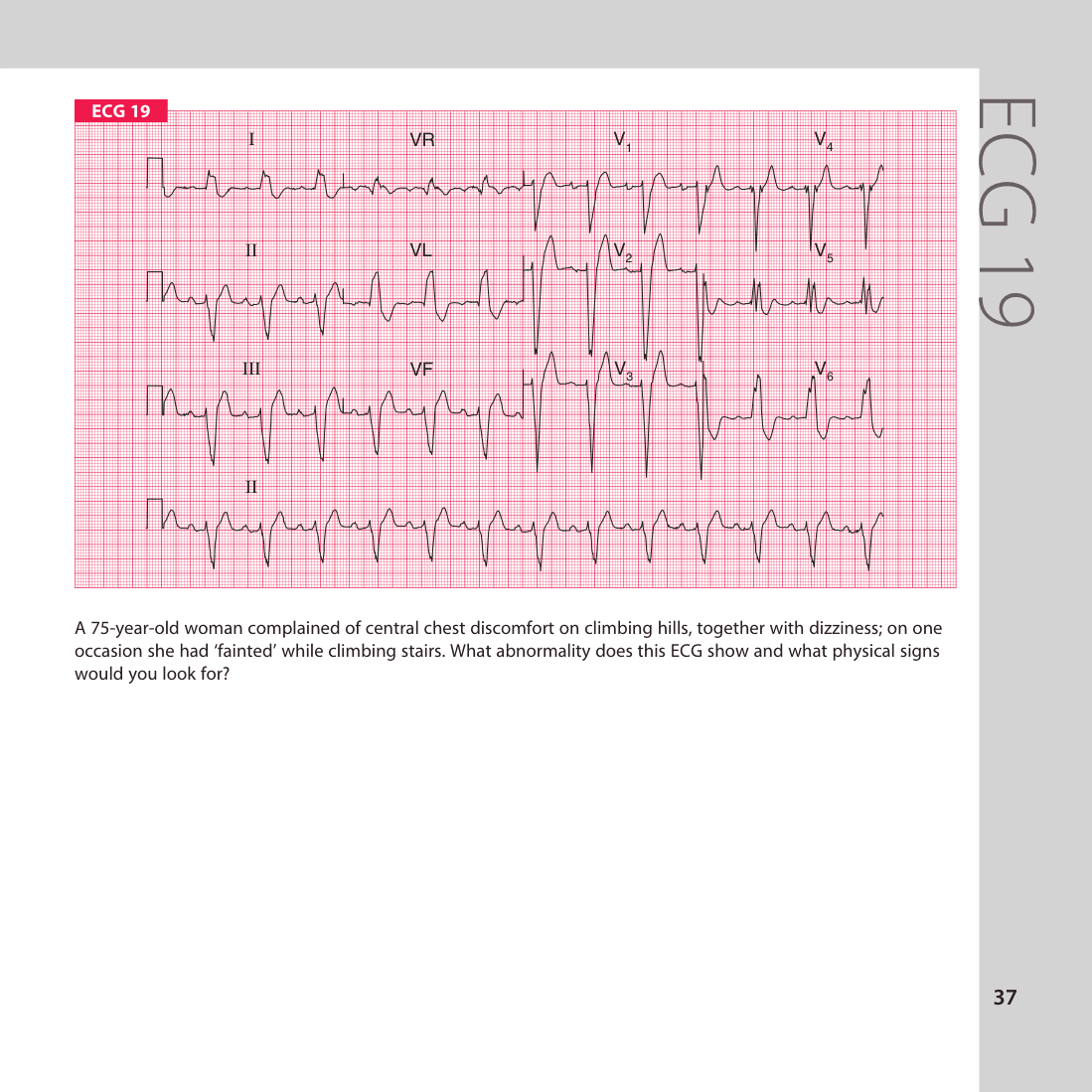 ECG 19