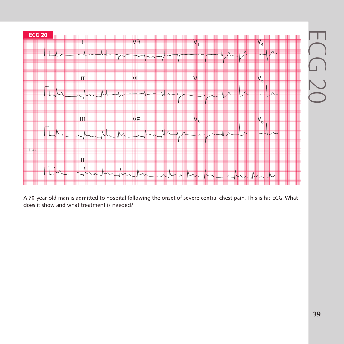 ECG 20