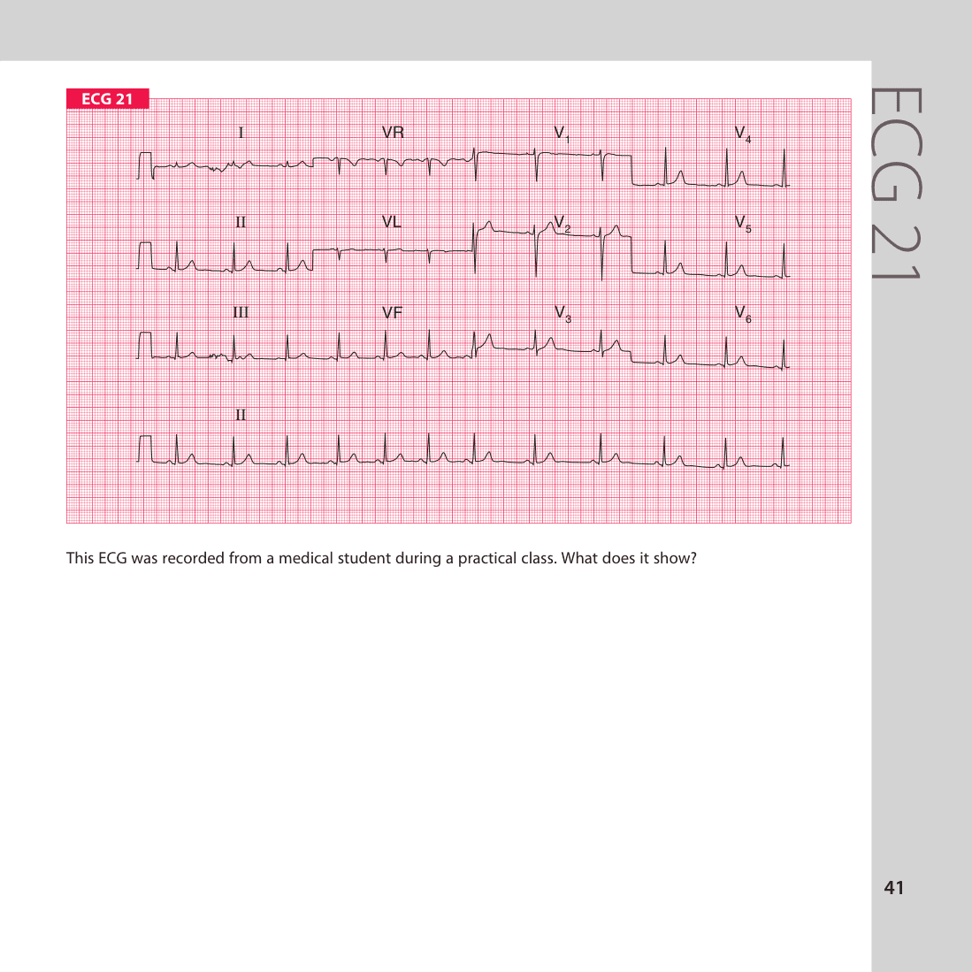 ECG 21