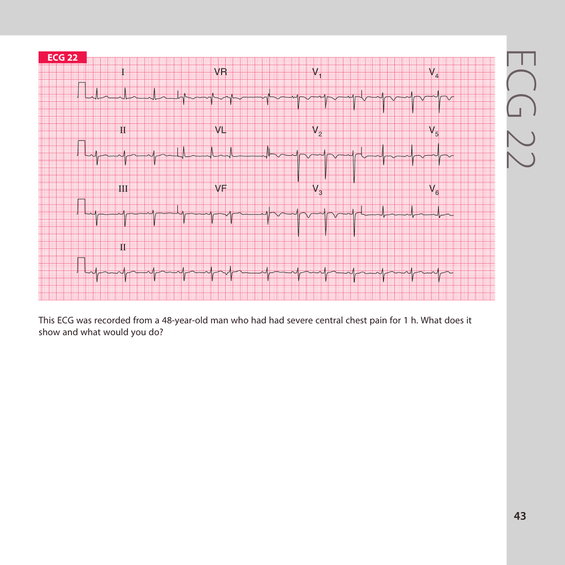 ECG 22