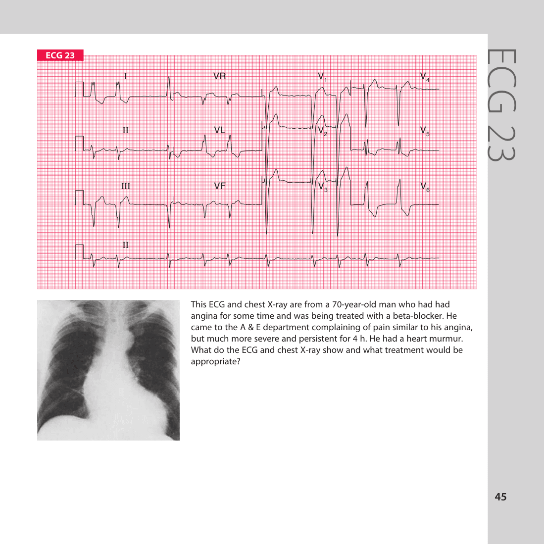 ECG 23