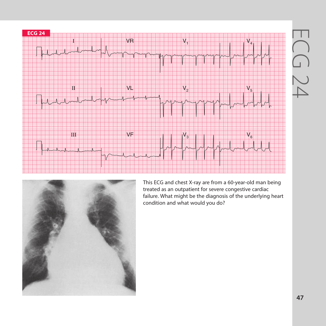 ECG 24
