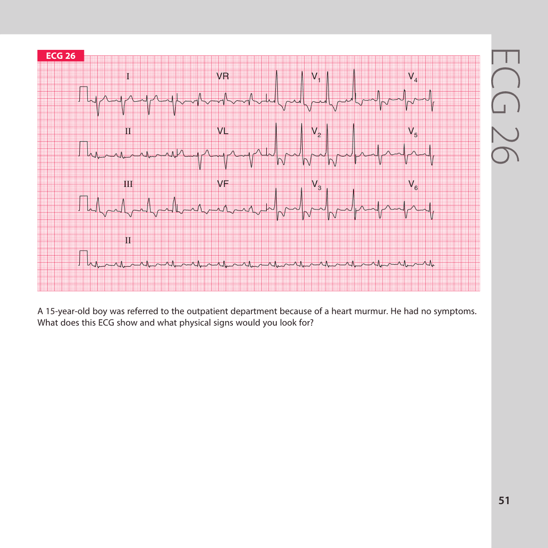 ECG 26