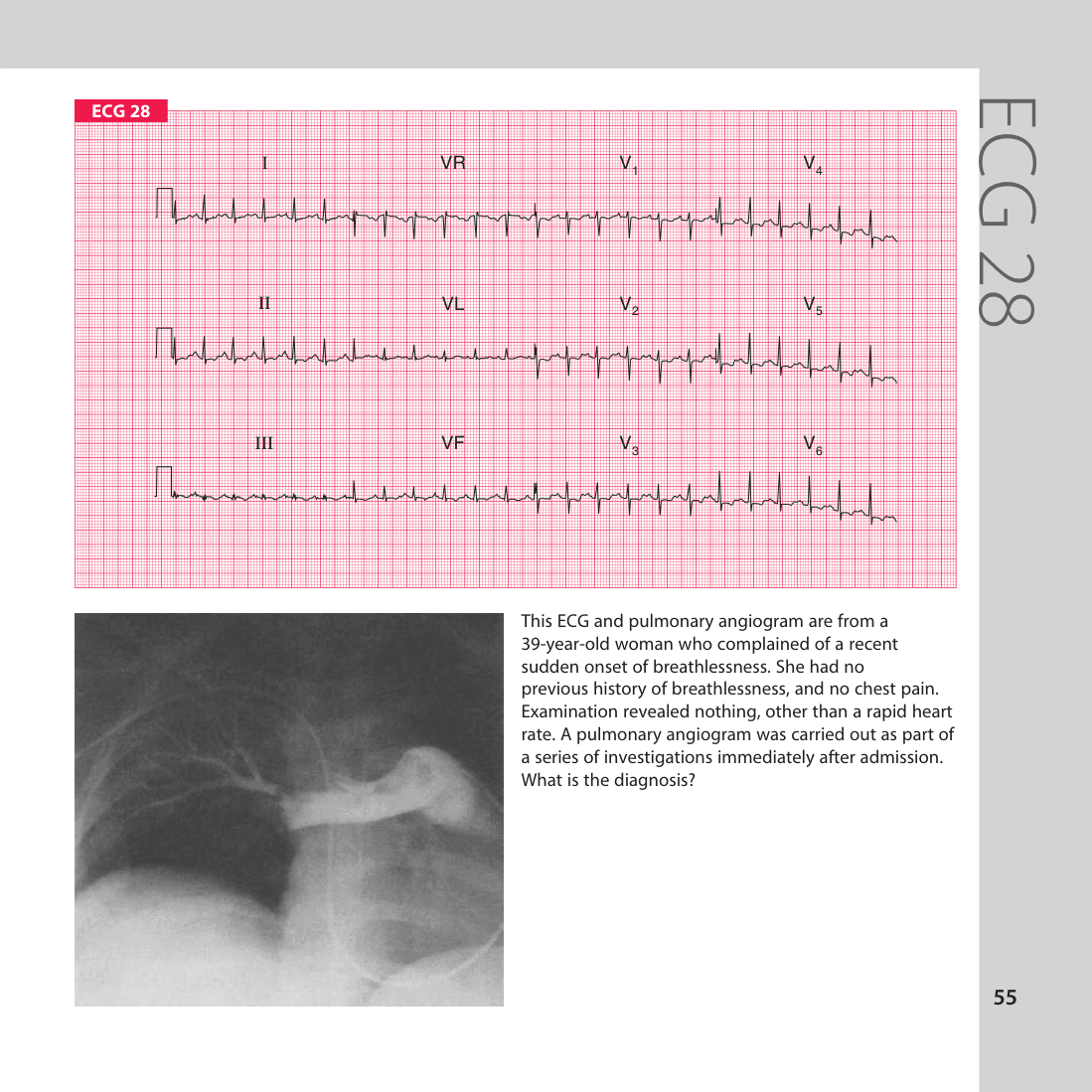 ECG 28