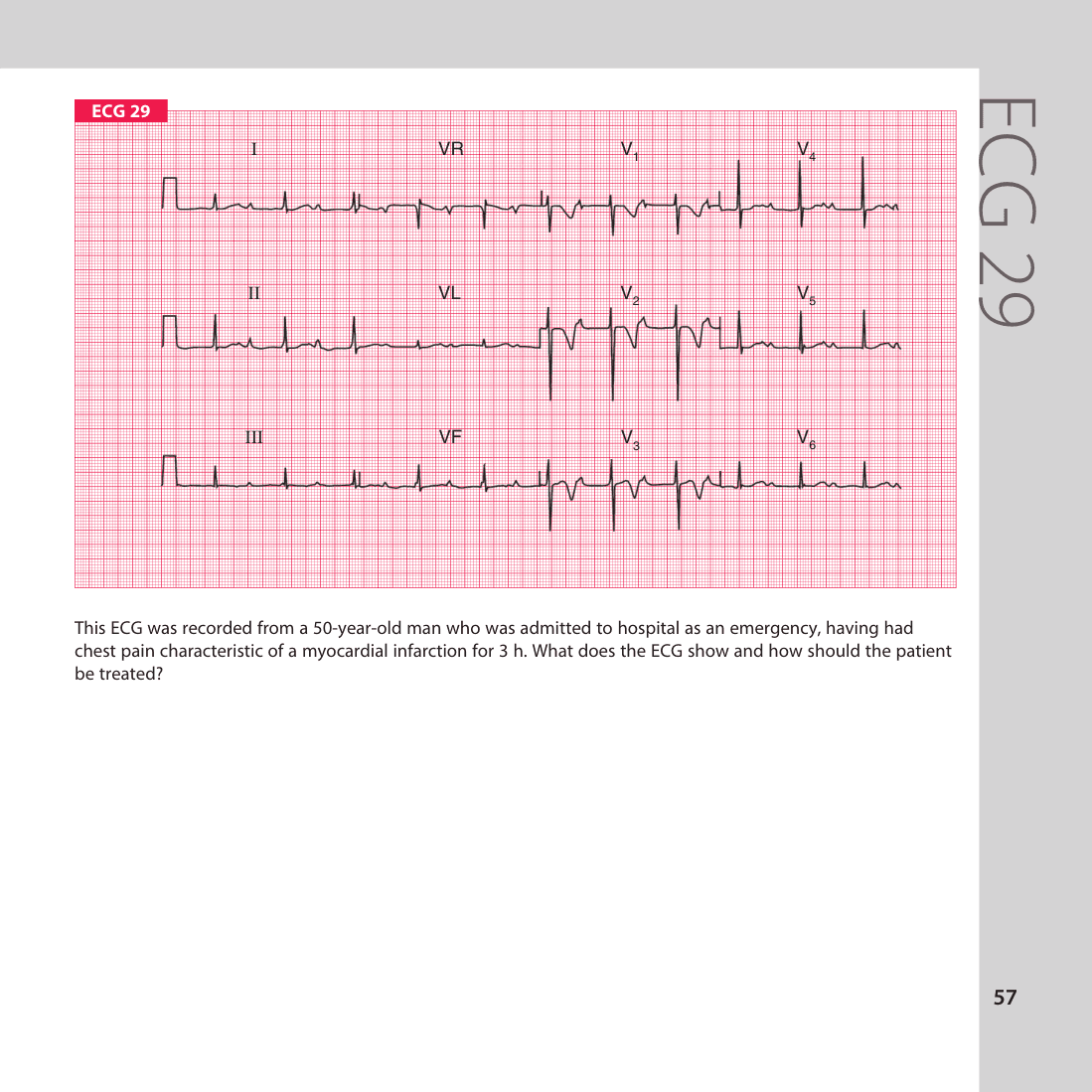ECG 29