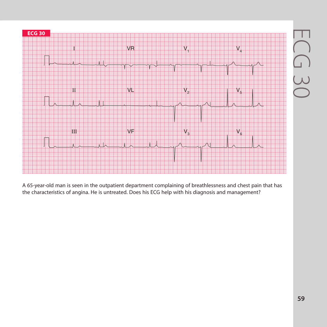 ECG 30