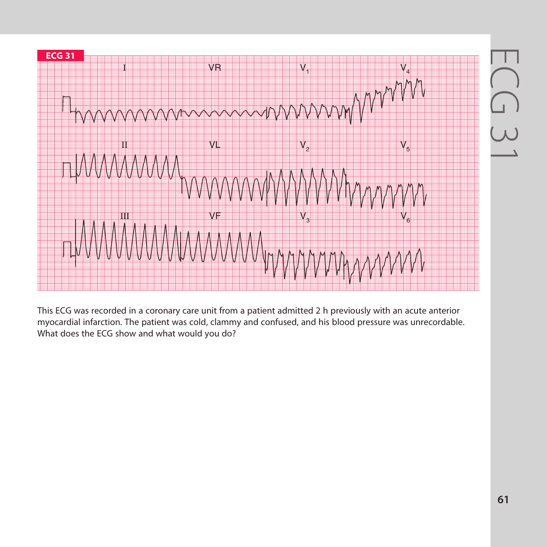 ECG 31