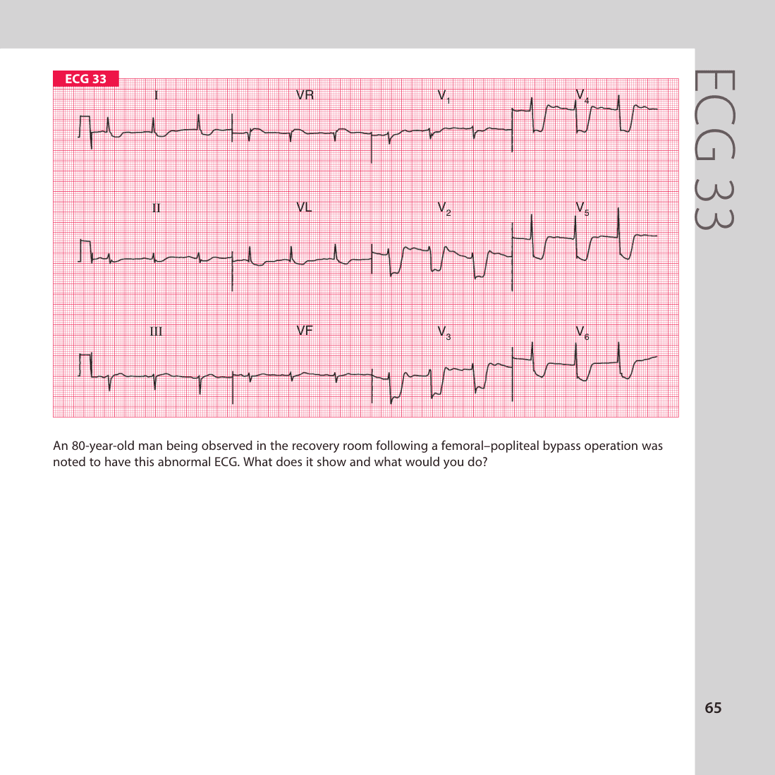 ECG 33