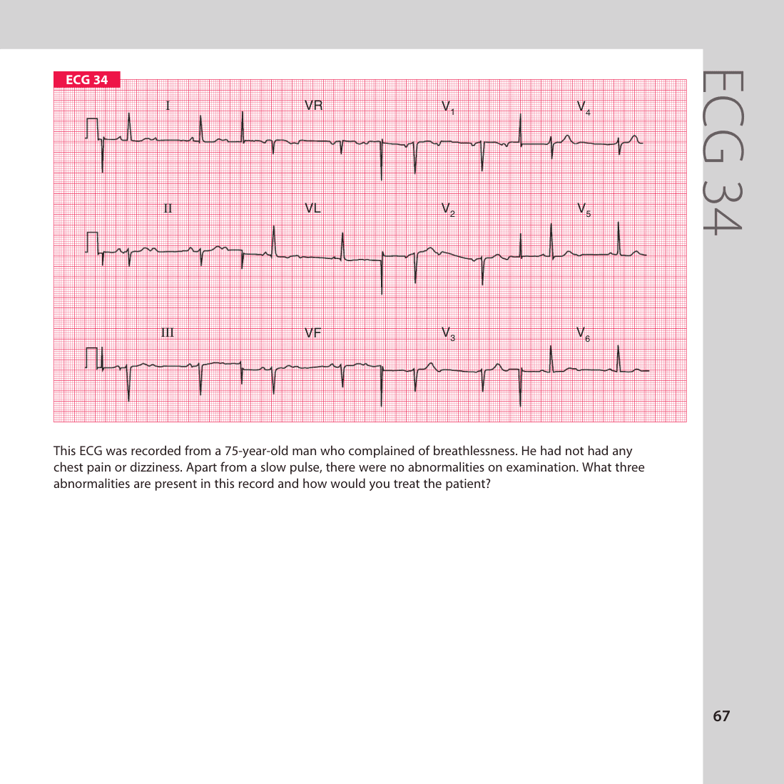 ECG 34