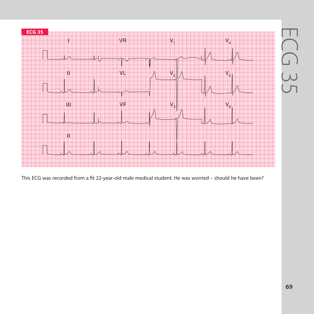 ECG 35