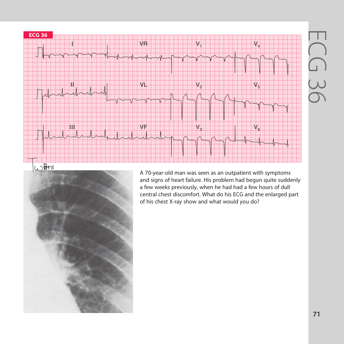 ECG 36