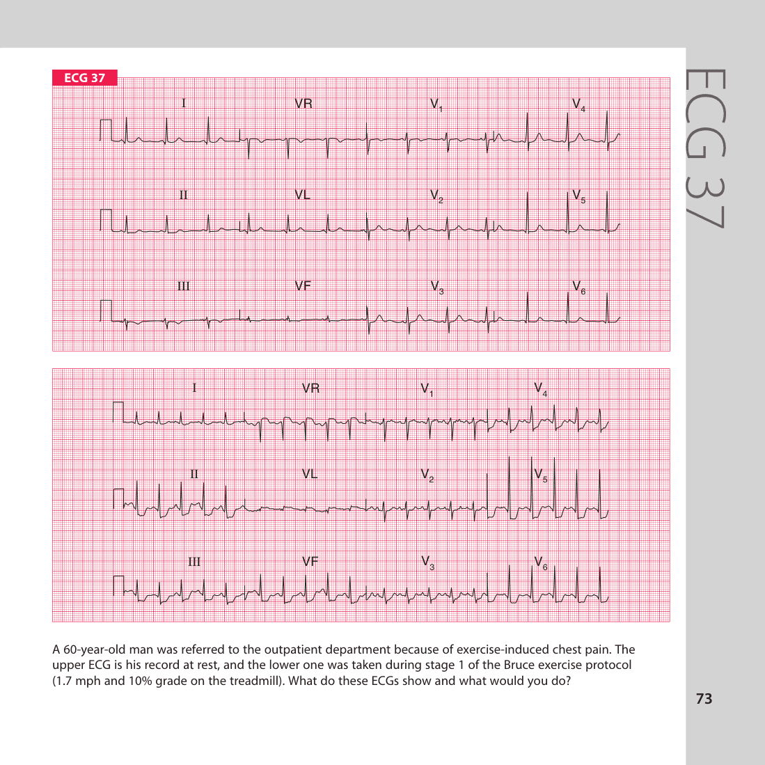 ECG 37