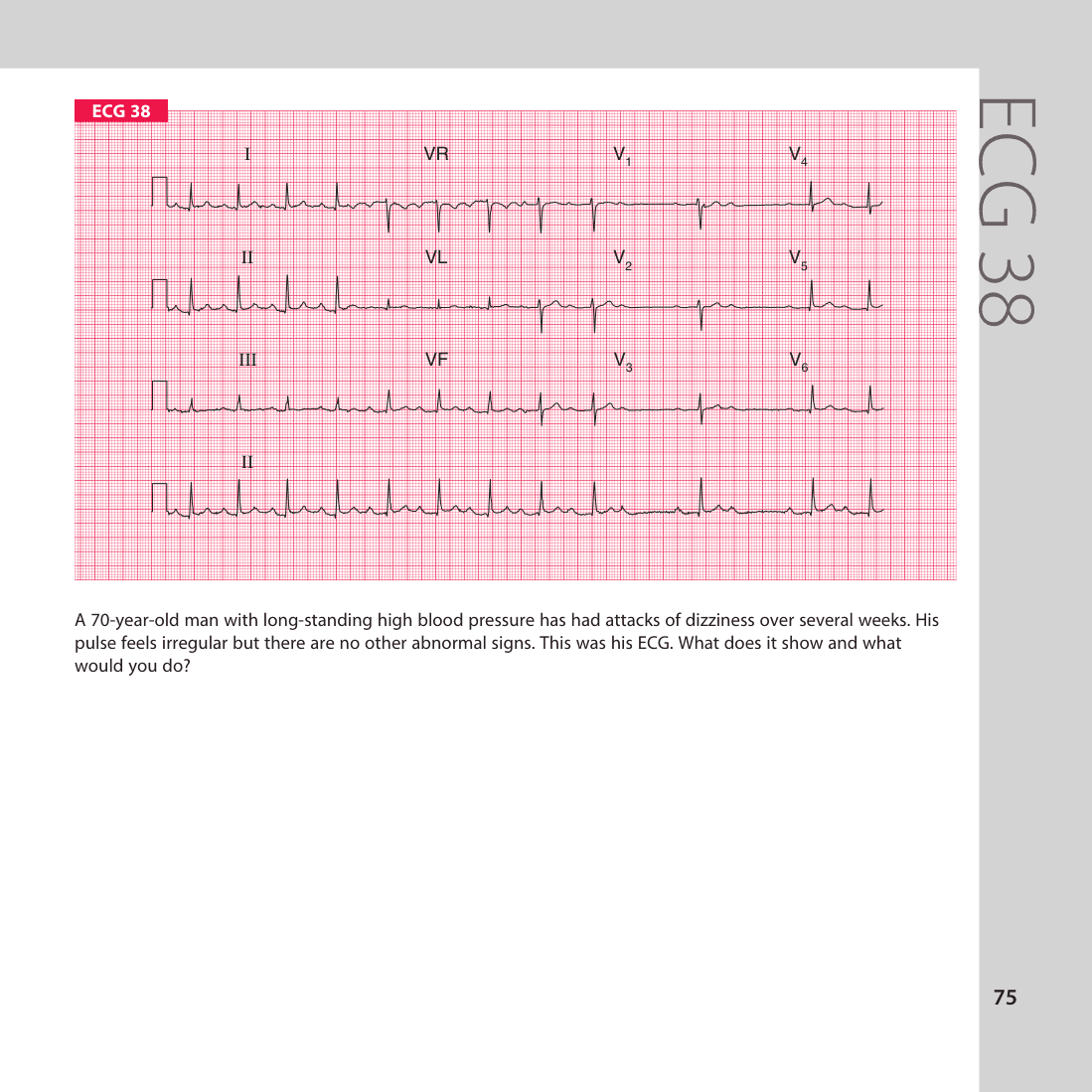 ECG 38