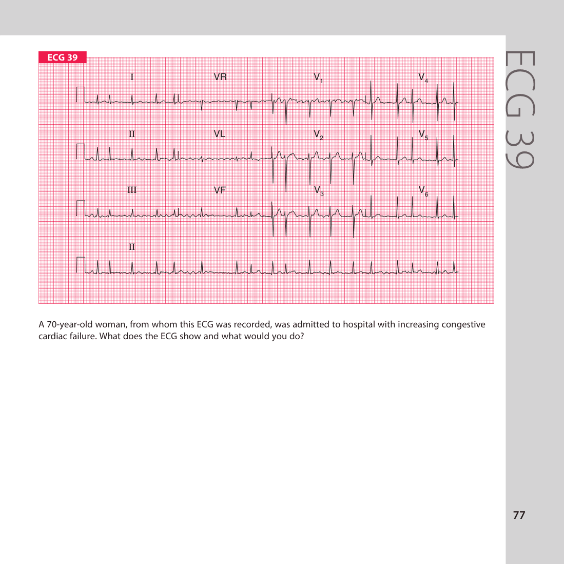ECG 39