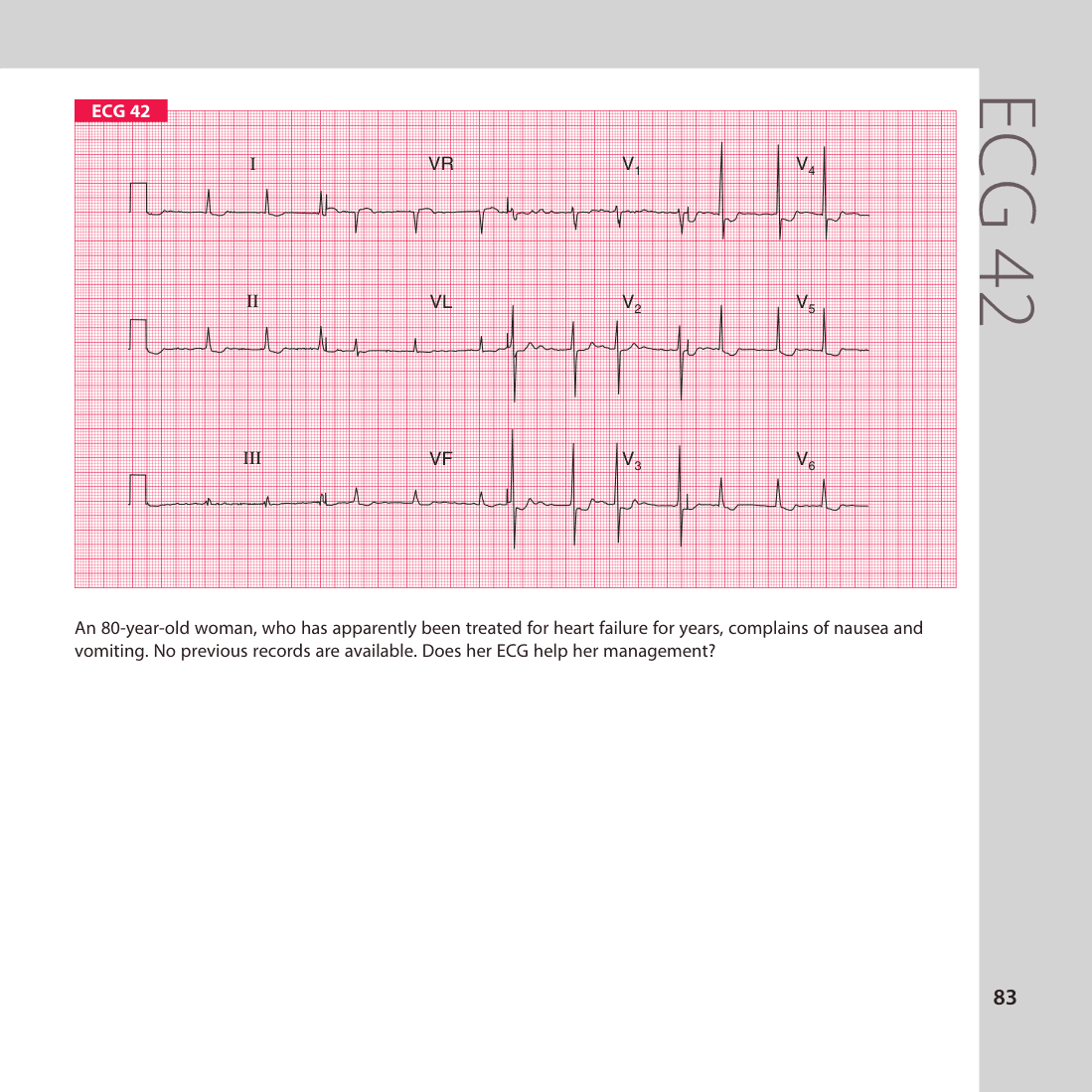 ECG 42