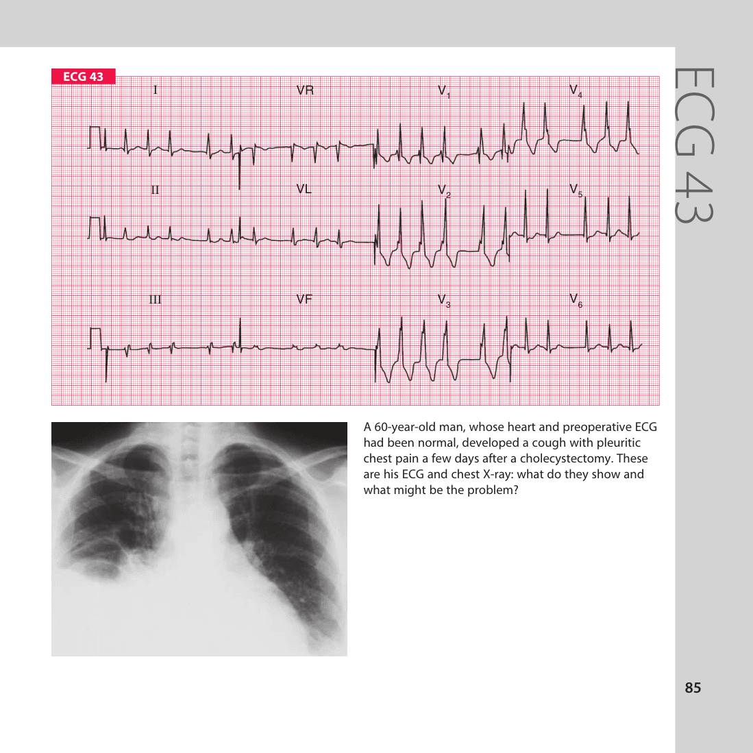 ECG 43