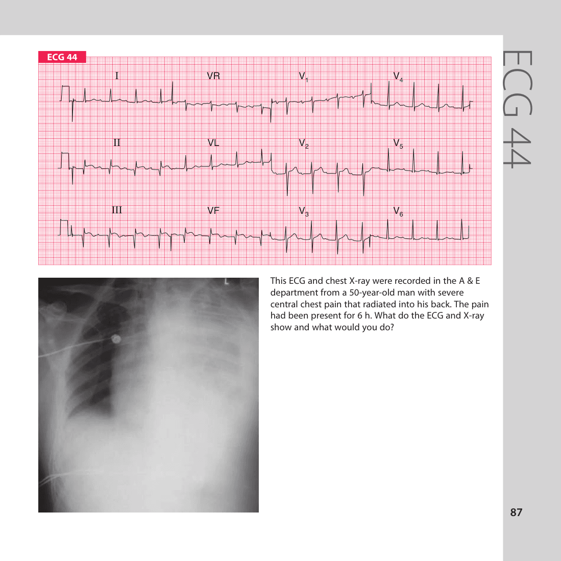 ECG 44