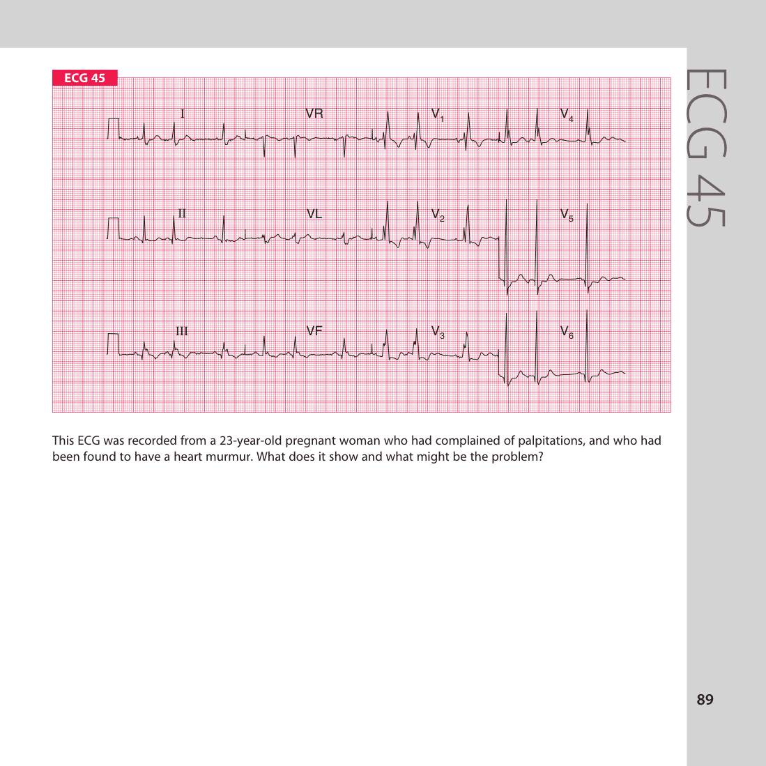 ECG 45