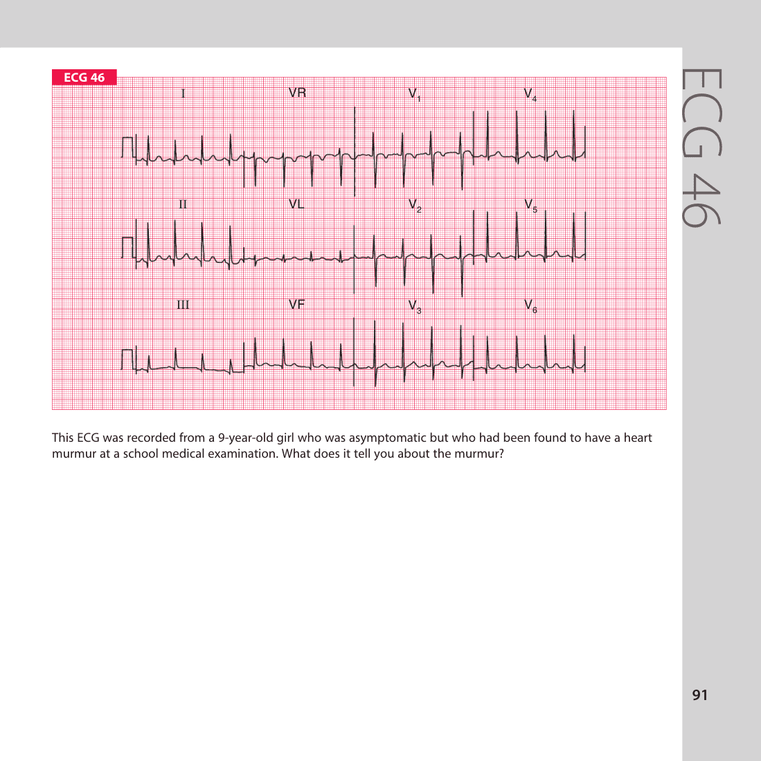 ECG 46