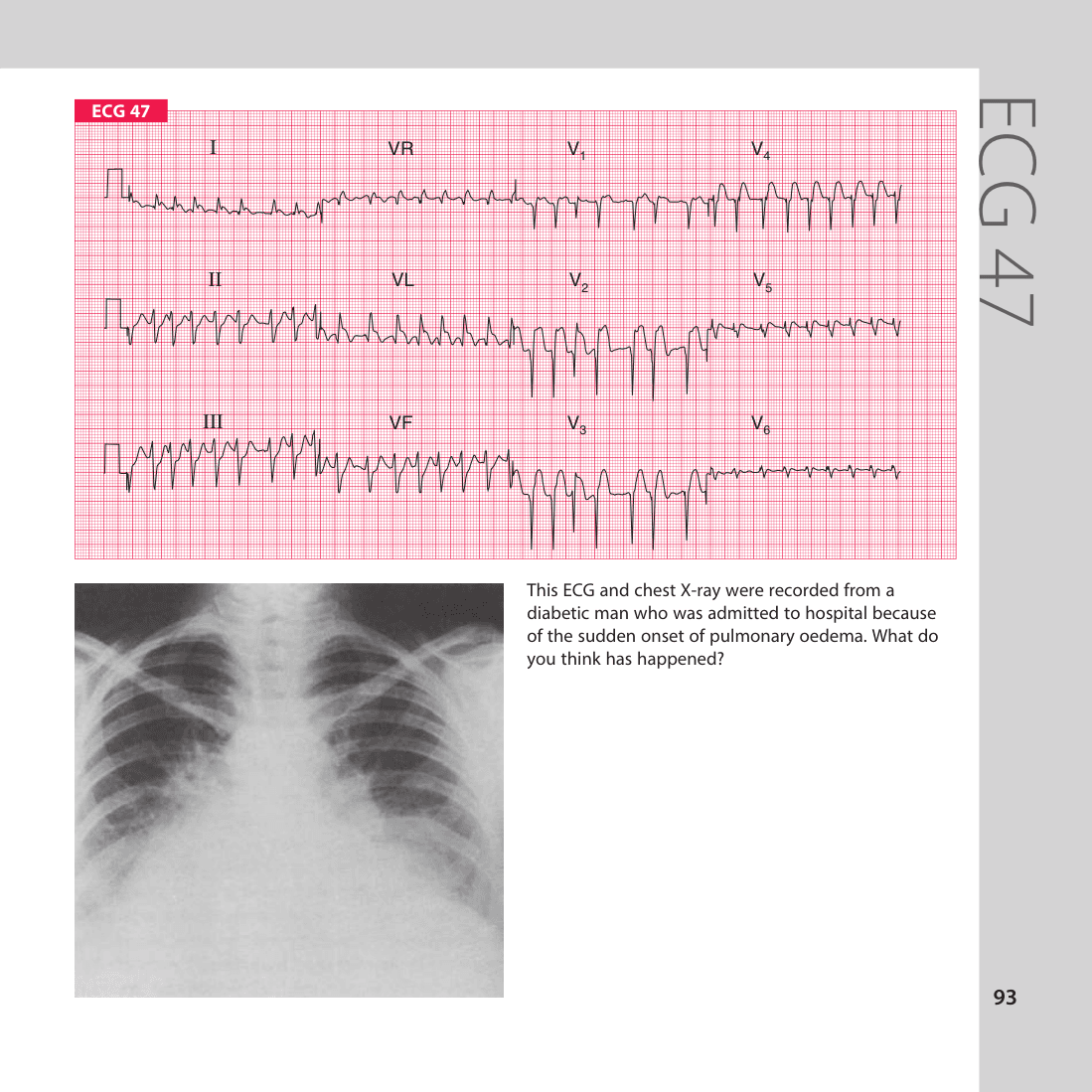 ECG 47