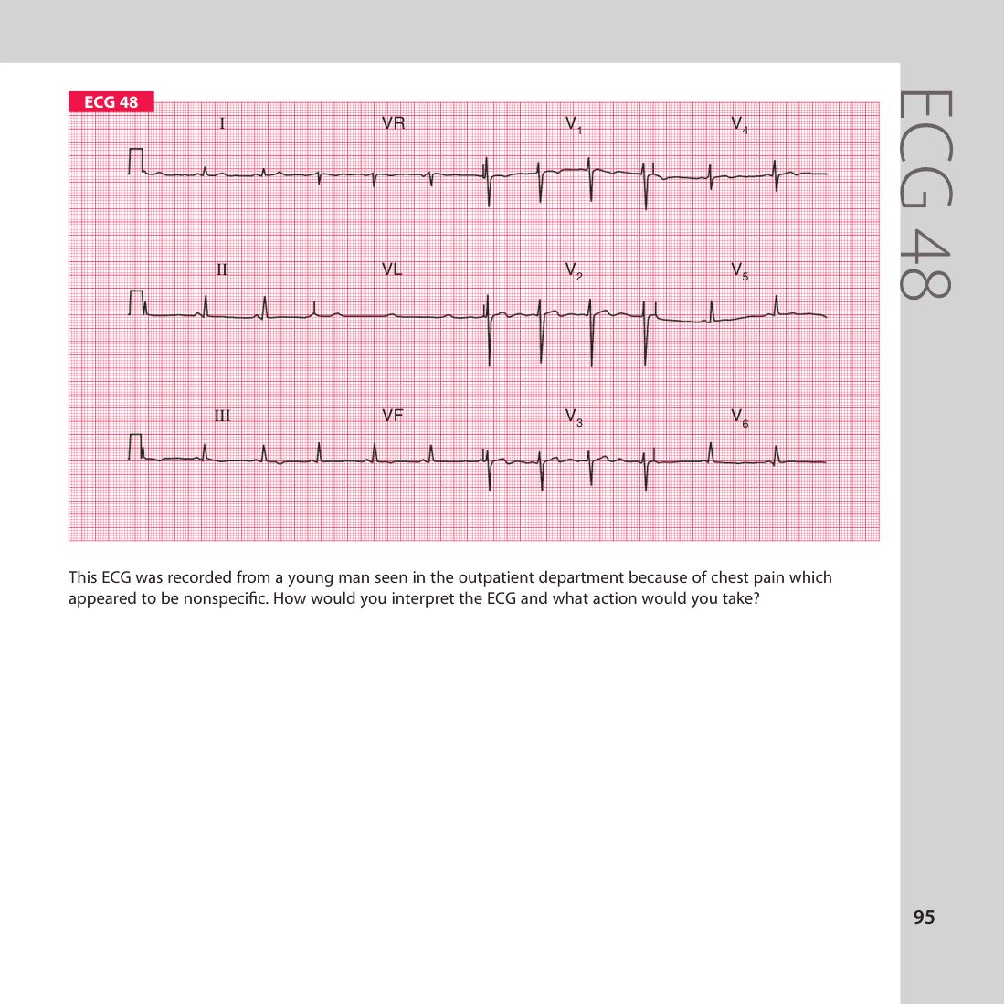 ECG 48