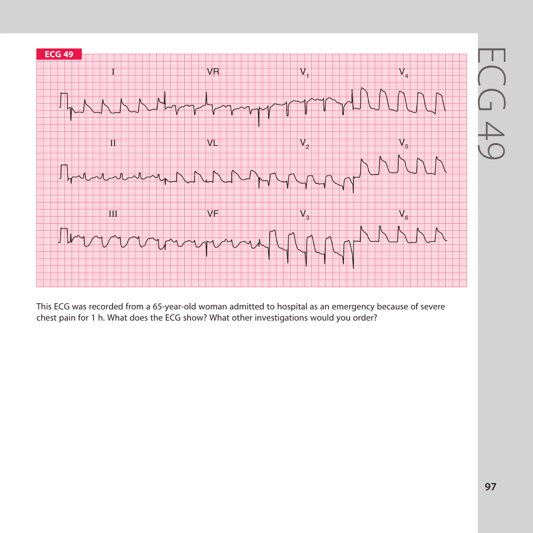 ECG 49