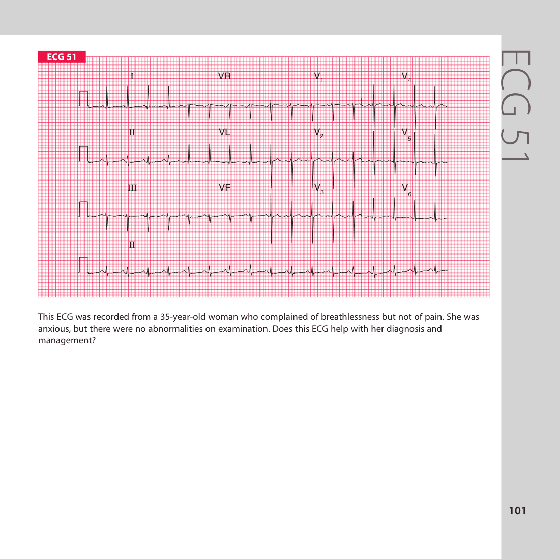 ECG 51