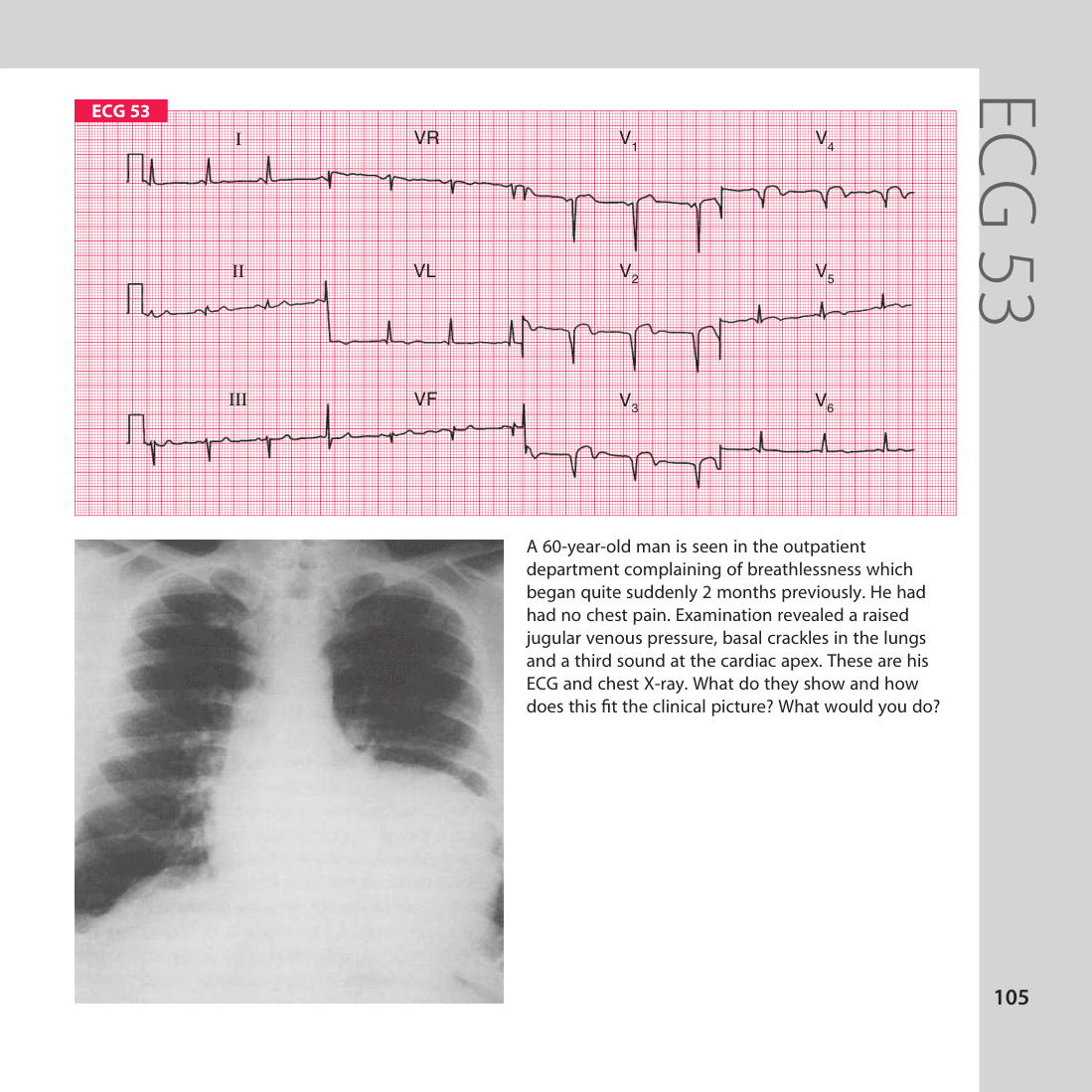 ECG 53