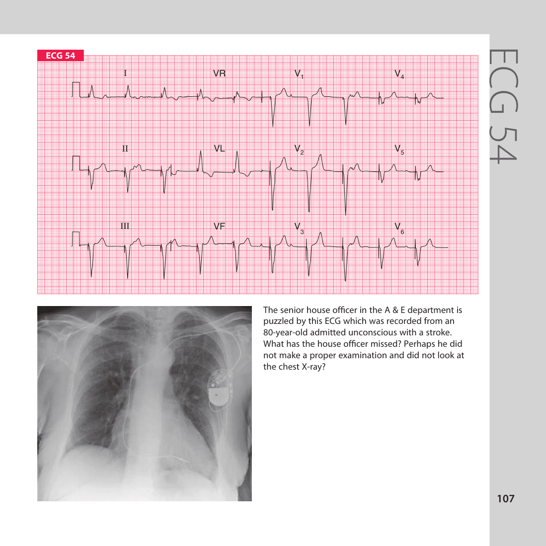 ECG 54