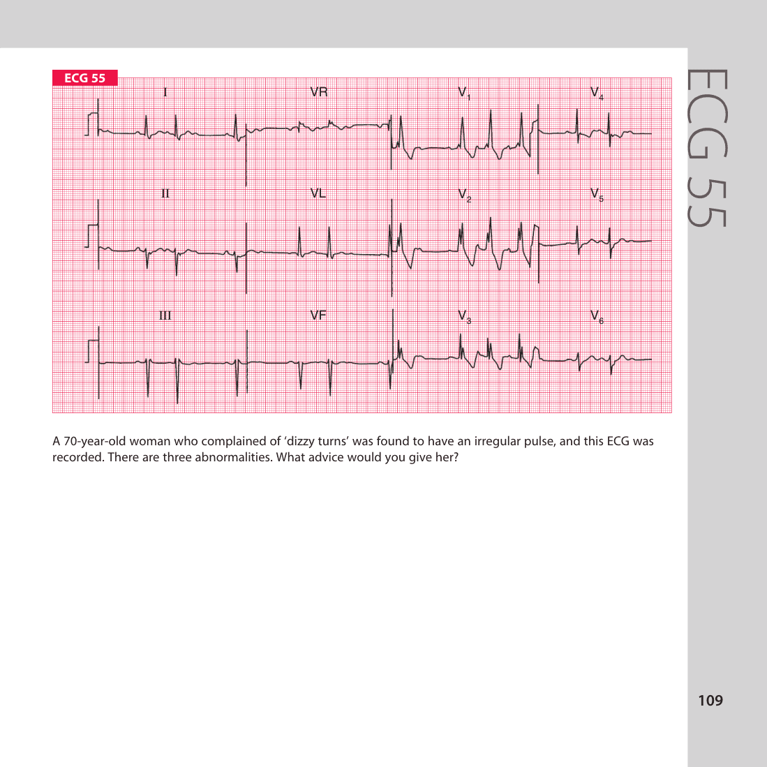 ECG 55