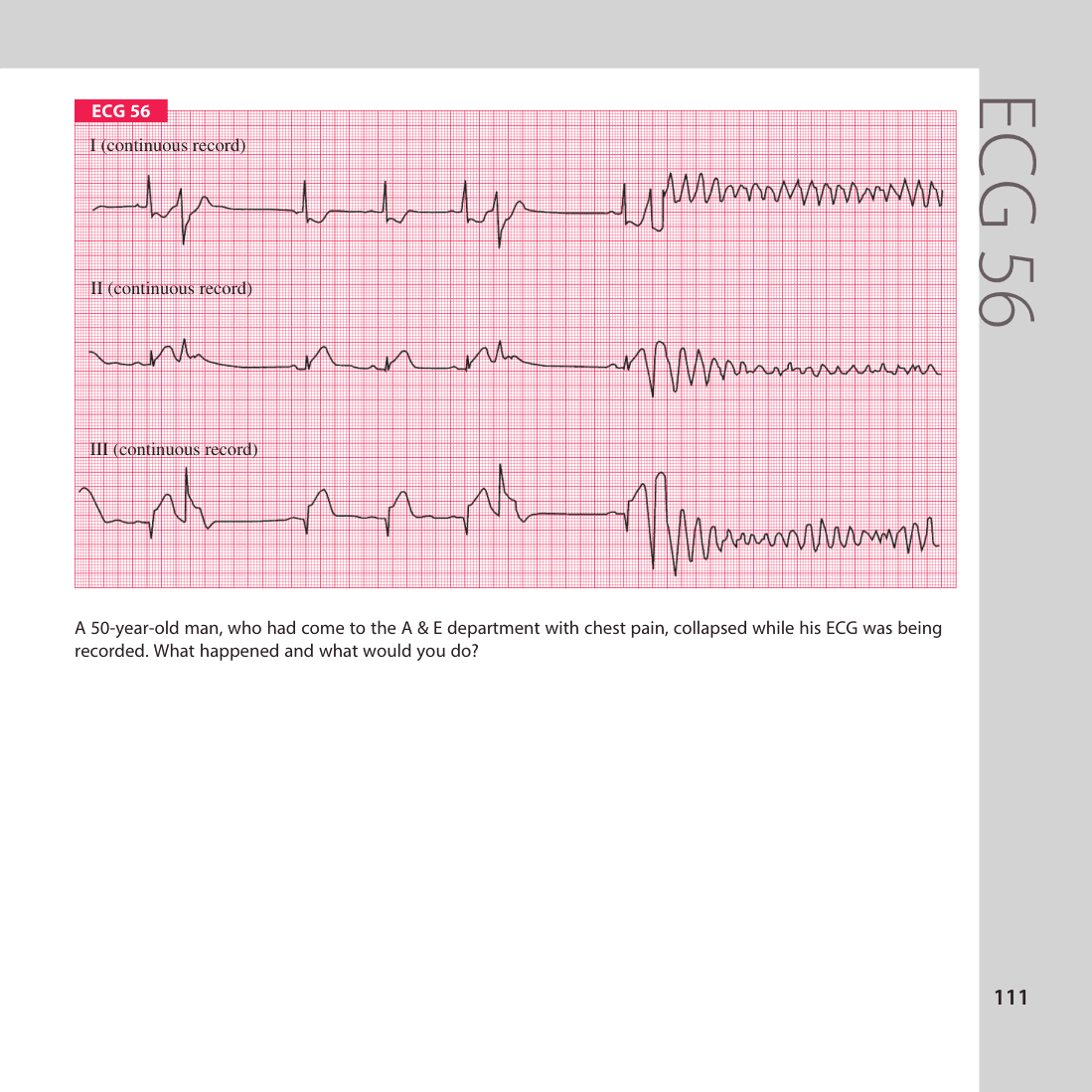 ECG 56