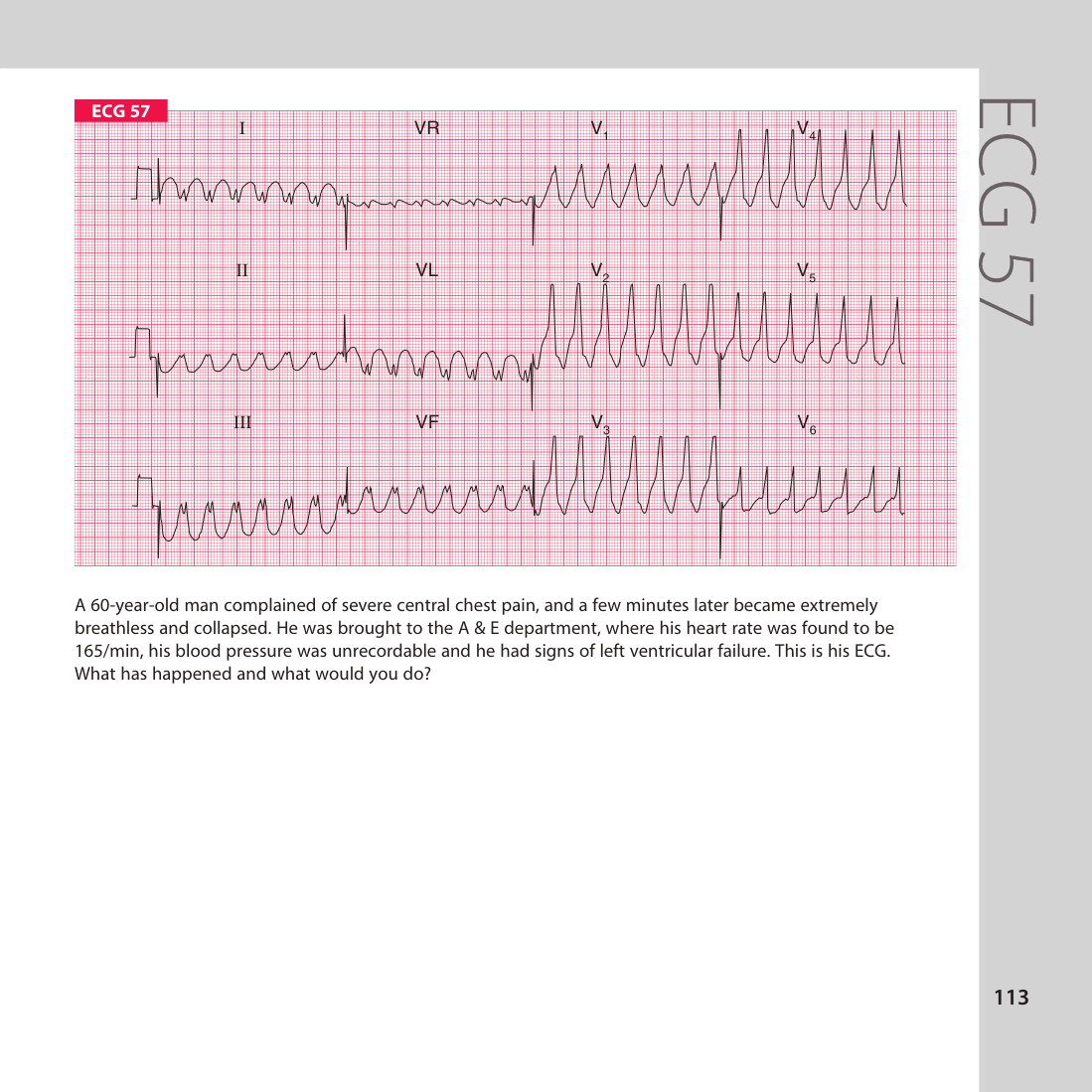 ECG 57