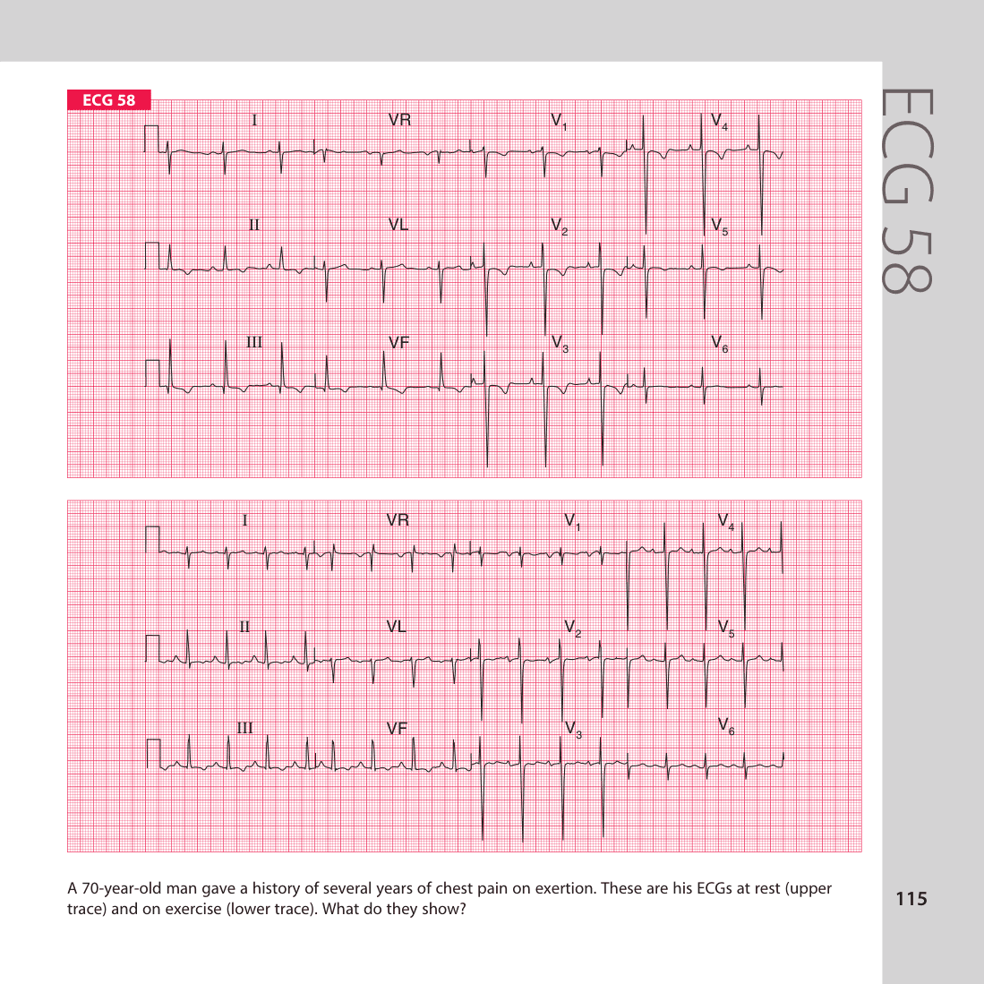 ECG 58